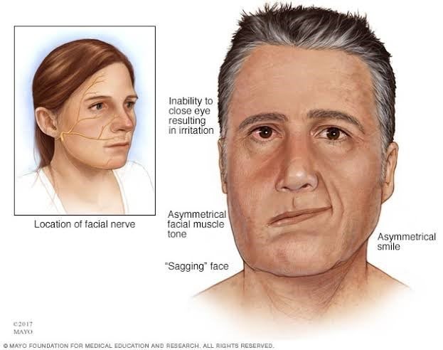 Bell’s Palsy